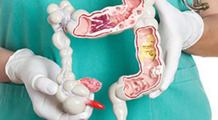 Cáncer de colon, uno de los más frecuentes, es prevenible con detección precoz