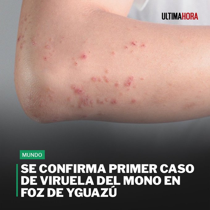 Se confirma primer caso de viruela del mono en Foz de Yguazú