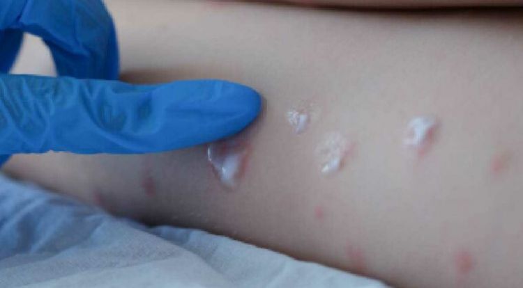 OMS descarta por ahora temores de una pandemia por la viruela del mono