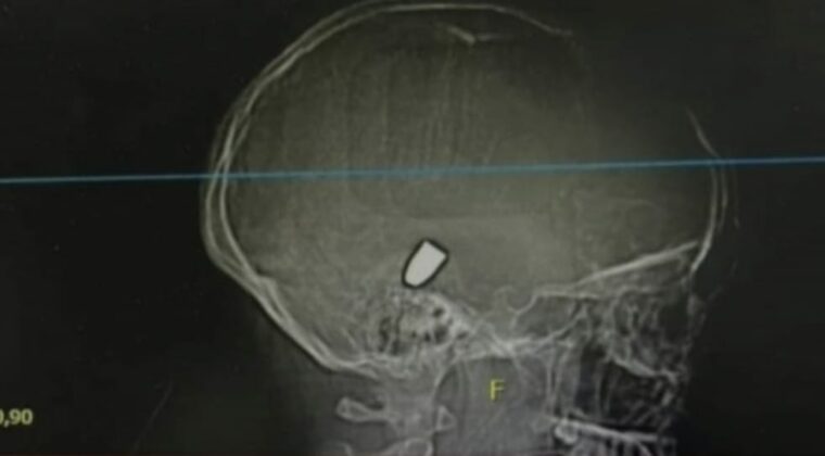 Niña recibió una bala perdida y la atendieron como si tuviera un golpe en la cabeza