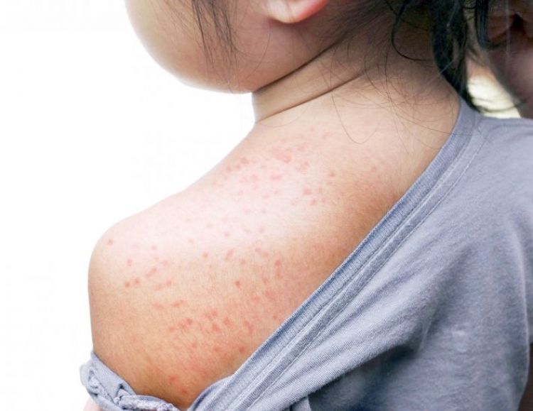 Ingreso de sarampión preocupa más que el coronavirus, dice ministro de Salud