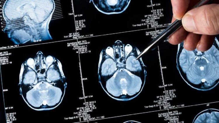 Una nueva plataforma agilizará la investigación en metástasis cerebral
